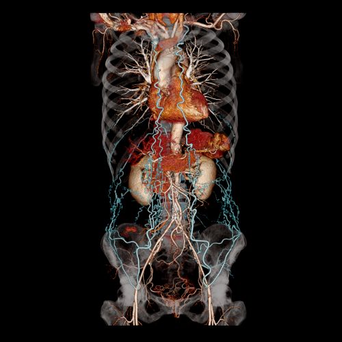 Chest, abdomen and pelvis CTA for aorta evaluation. The abdomina